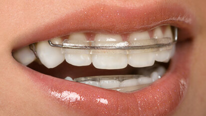 Kritiek op orthodontiekorting door NZa