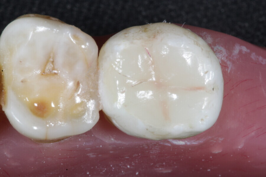 Fig. 34: The final occlusal layer of the restoration is placed using an enamel supra-nano hybrid composite in Shade A2 (Estelite).