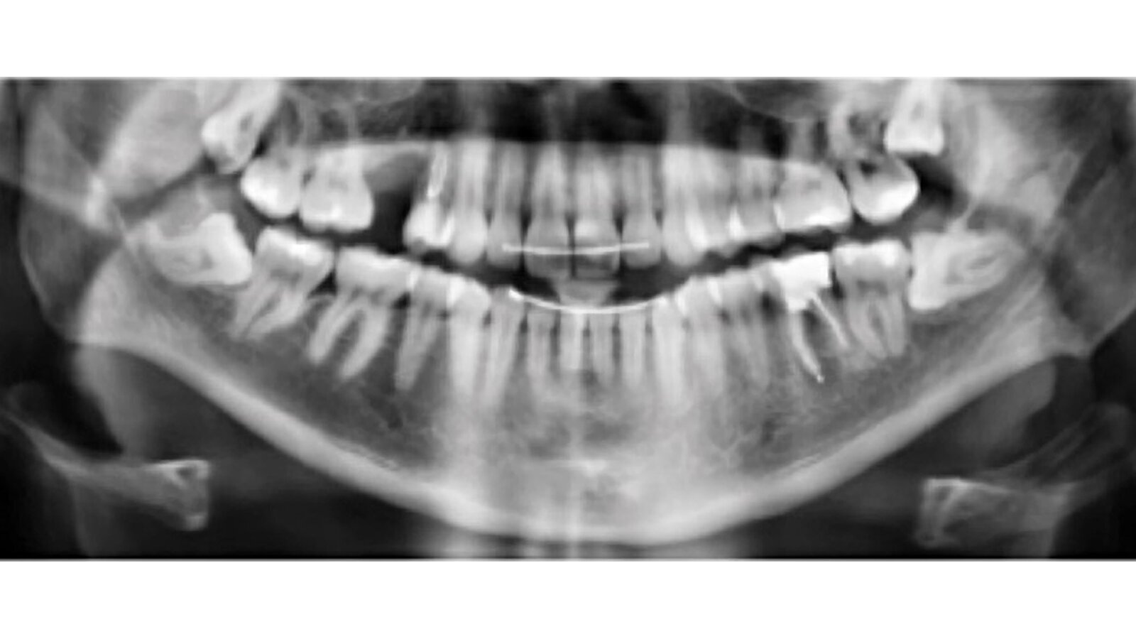 Retratamiento no quirúrgico de una perforación