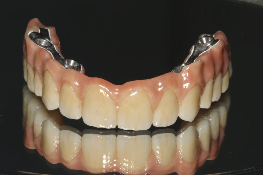 Fig. 17: Definitive prosthesis consisting of an Atlantis BridgeBase and zirconia.