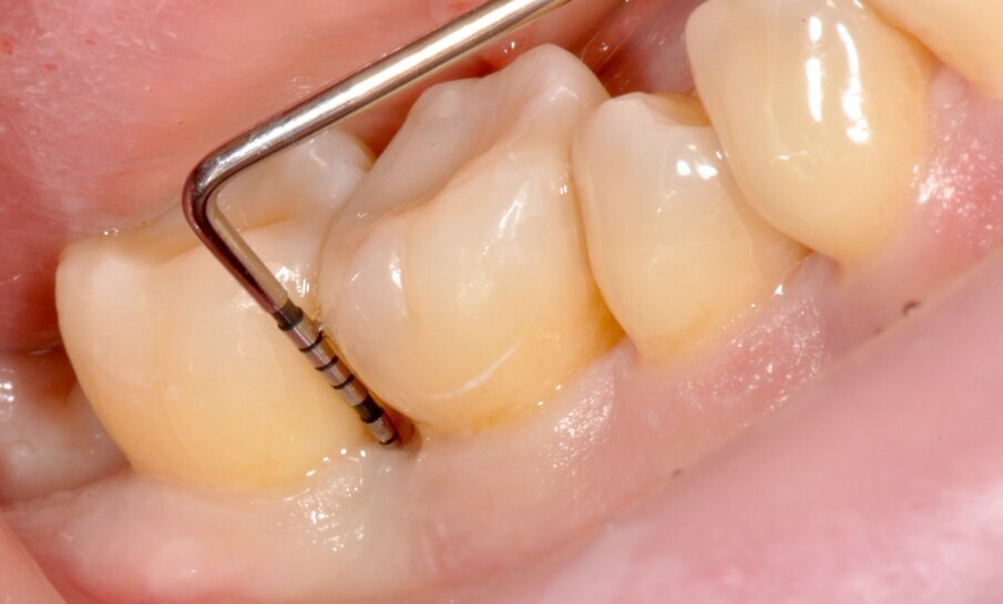 Fig. 4 - Sondaggio DV dell’elemento 4.6 di 9 mm.