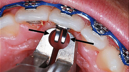 BiTurbo2 (BT2) systém pro rychlou úpravu hlubokého skusu