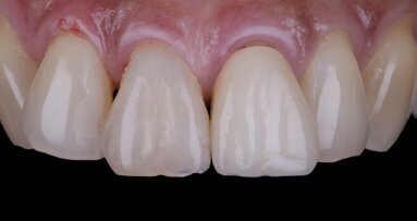Immediate implant placement in the aesthetic zone: Two-year follow-up
