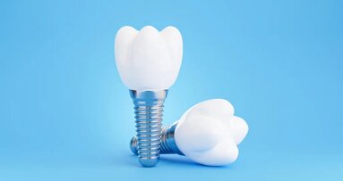 Impianti dentali fatti su misura grazie alla stampa 3D