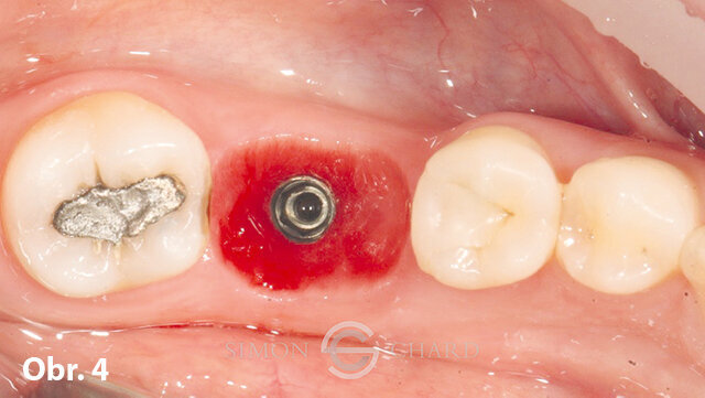 Formování měkkých tkání po dobu 3 týdnů