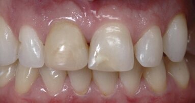 Estética y blanqueamiento dental en la era digital  (Capítulo 17)