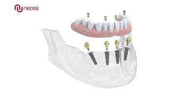 Neoss Group annuncia il lancio del Multi-Unit Abutment: la soluzione di trattamento Neoss4+ per arcate complete