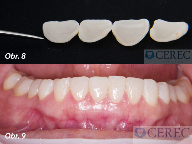 Ordinačně vyrobené fazety před nasazením / Fotografie po fixaci fazet