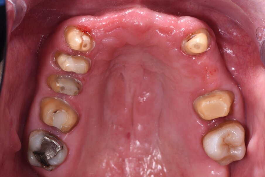 Fig. 17_Visione occlusale a preparazione degli elementi naturali ultimata in preparazione orizzontale a chamfer. 