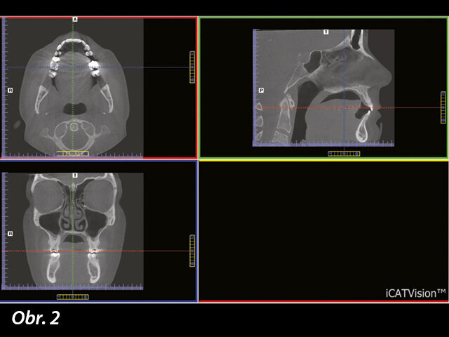 Software CBCT umožňuje zhotovit axiální, koronální a sagitální řez