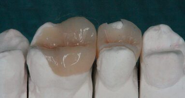 Riabilitazione diretta e indiretta mediante l’ausilio della stessa resina composita: case report