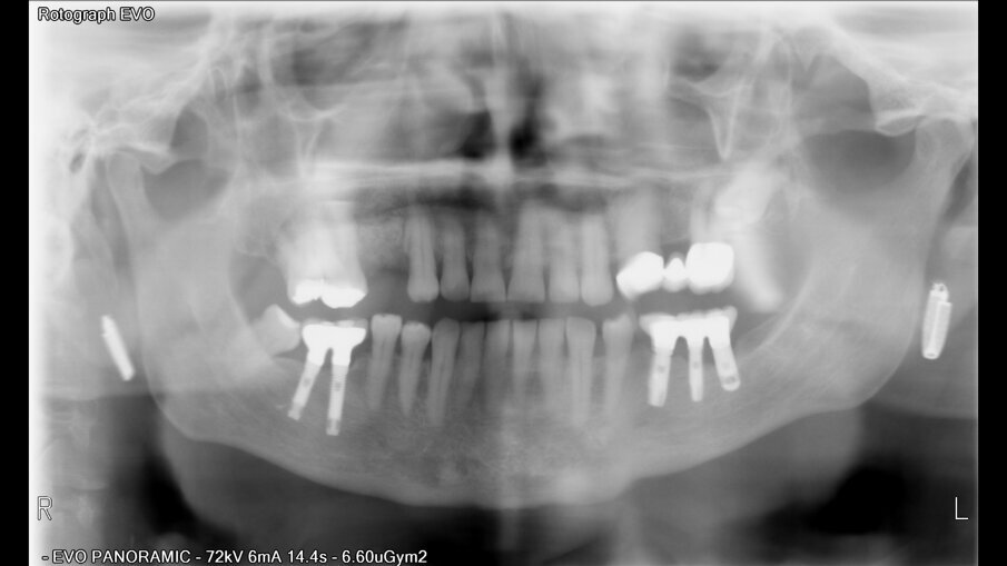 Implantát s novou korunkou.