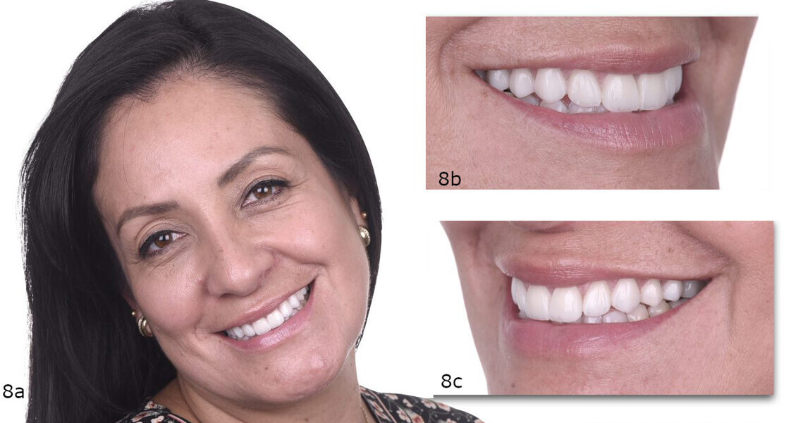 Figs. 8a–c: Final views of the aesthetic outcome.