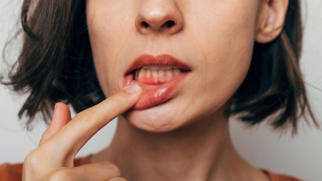 Global periodontitis burden rises sharply despite stable rates, data shows