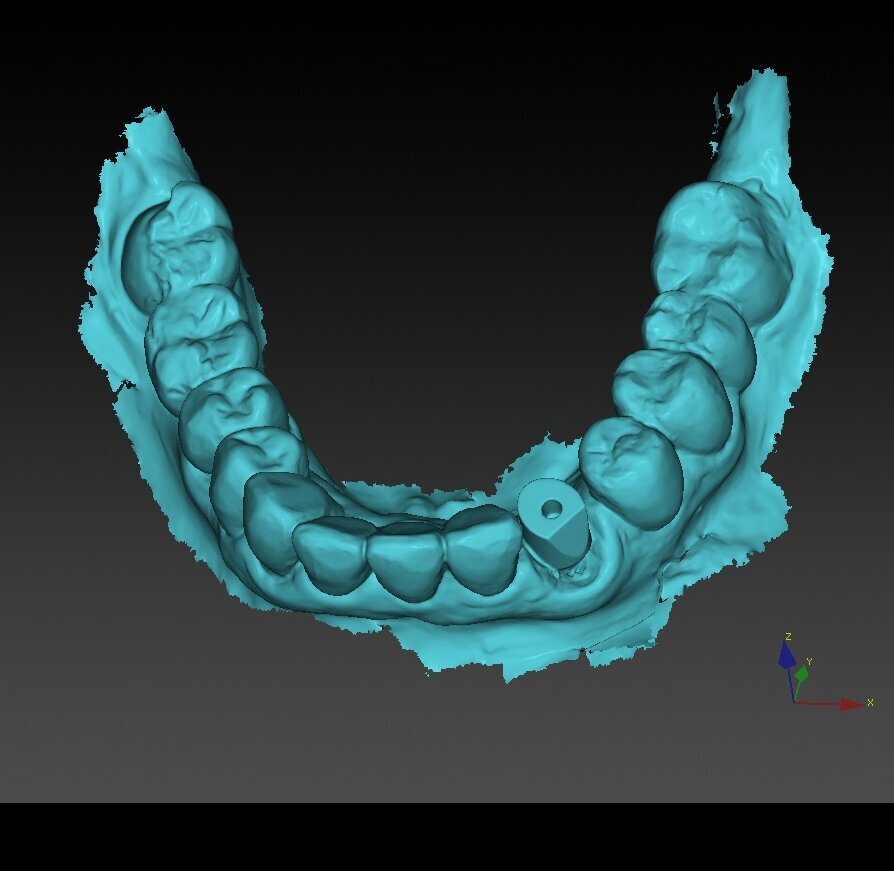 Fig. 14_Scansione intraorale a 3 mesi dalla prima chirurgia.