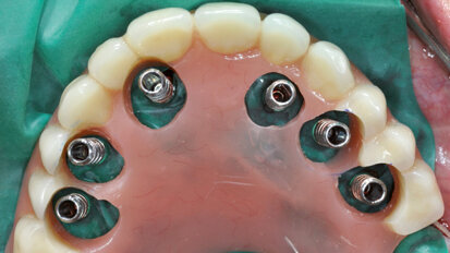 Restauro immediato su impianti nel mascellare edentulo