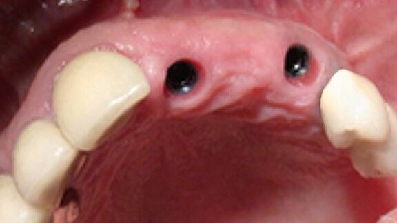 Prothèse partielle fixe implanto-vissée