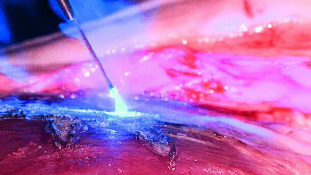 Il laser in odontoiatria un mercato in costante crescita