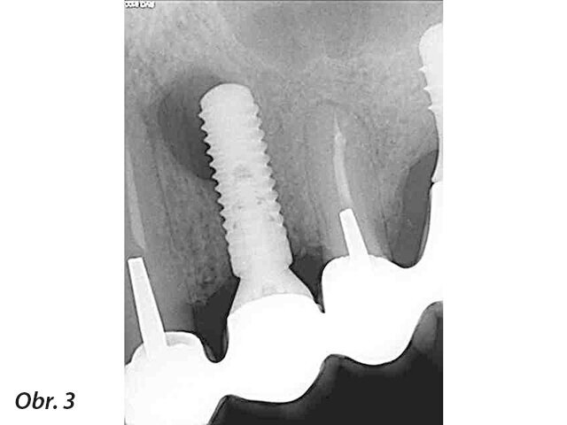 Periapikální léze implantátů a retrográdní periimplantitis