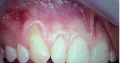 Le recouvrement de récession radiculaire devient prévisible, grâce à des membranes résorbables