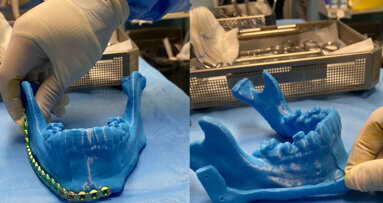 Surgeons in Tabuk reconstructed the jaw of 25-year-old patient with 3D printing
