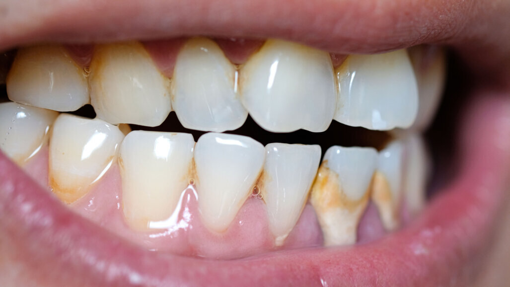 Tandarts Charlotte Jorna: “Tandsteen is zoals een kalkkring in de wasbak”