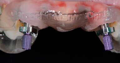 Flusso digitale e provvisorio post-chirurgico: nuova procedura clinica per il carico immediato