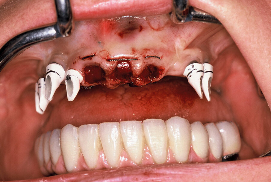Fig. 7. Provisional implant abutments and extraction sockets.