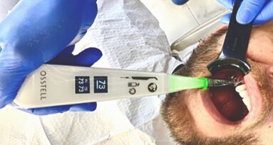 ¿Cómo predecir el éxito de los implantes?