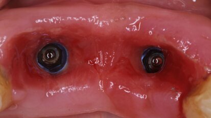 Rise of minimally invasive techniques for soft tissue augmentation – A tale of promise and pitfalls