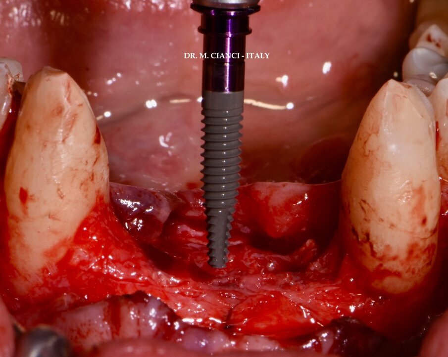 Fig. 6 - Superficie UnicCa BTI. 