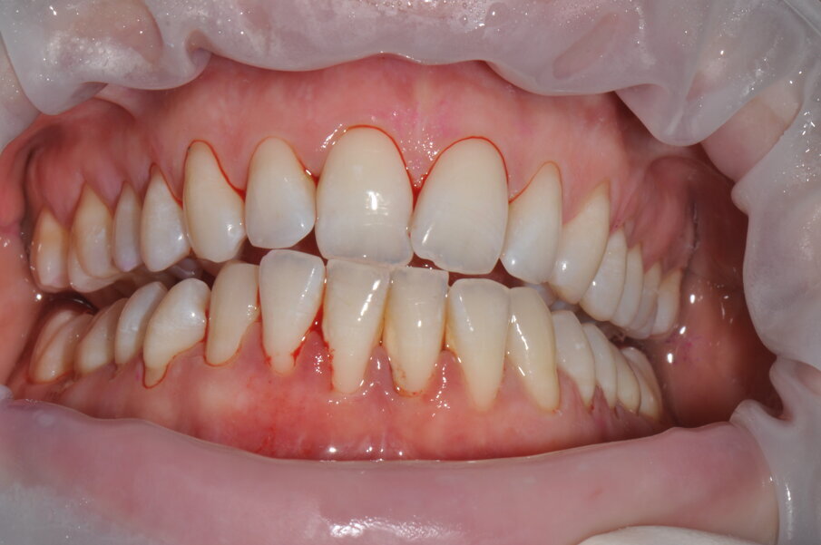 Figg. 2a-2c - Foto scattate dopo l’utilizzo del manipolo sopra-gengivale, nelle aree vestibolare (2a), palatale (2b) e linguale (2c), senza la detartrasi con strumento piezoelettrico.