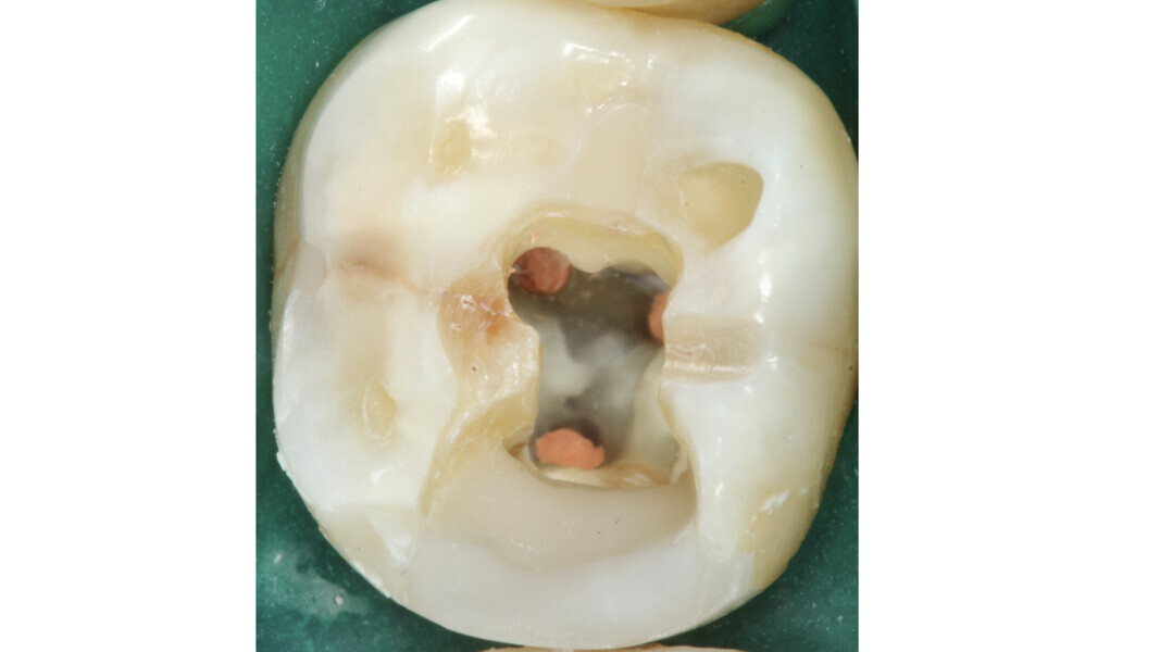Fig. 19 : Aspect de la cavité pulpaire après l’obturation : il faut noter l’opacité typique du plancher sans la moindre calcification.