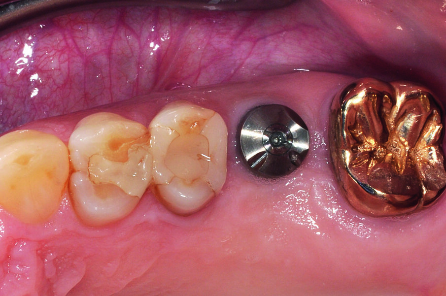 Fig. 6: The gingiva former BellaTek Encode after eight weeks.