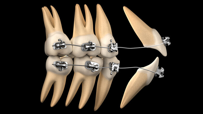 Přehled klinické ortodoncie: Mechanika léčby, část I.
