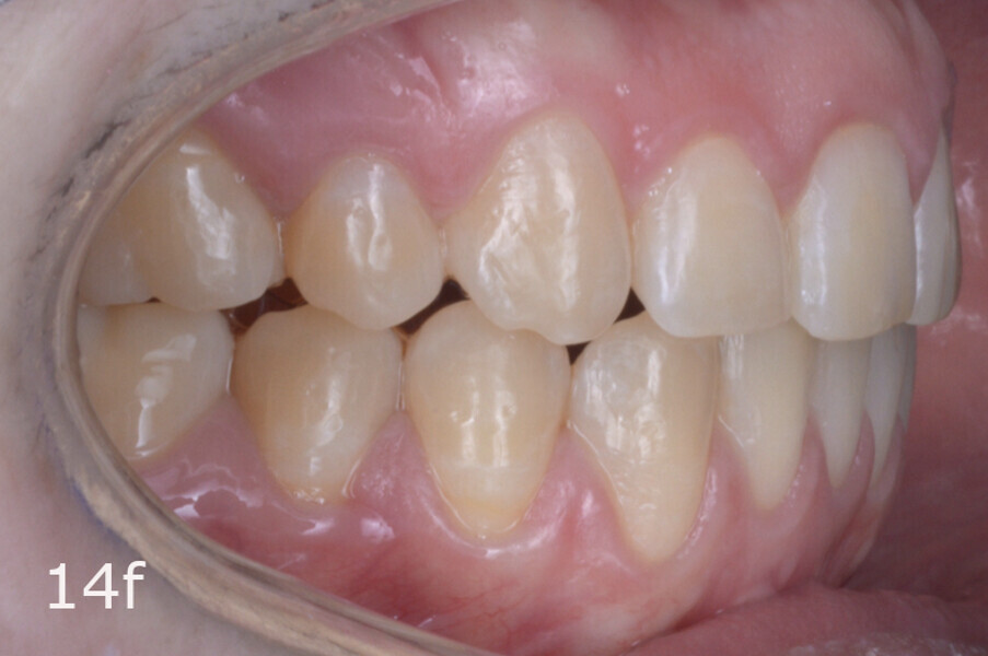 Figs. 14a–h: Intra-oral comparison of the situation (a, d, e & h) before and (b, c, f & g) after treatment.