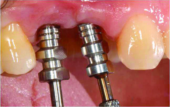 Fig. 11_Il condizionamento del tessuto molle è stato ottenuto modificando gradualmente l’emergenza della protesi provvisoria in diversi appuntamenti e trasferito con l’impronta al laboratorio.