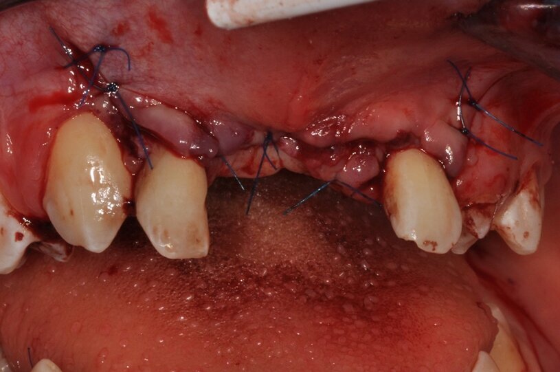 Ryc. 10_Stan bezpośrednio po drugim zabiegu.