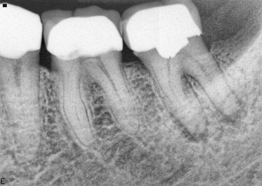 Fig. 17a: Case assisted with CBCT to determine anatomy pre-operatively. Note the multiple cross sections moving apically and the correlation to the 2-D view. Note also the conservative taper in relation to the root width. (Courtesy of Dr. Brett Gilbert)