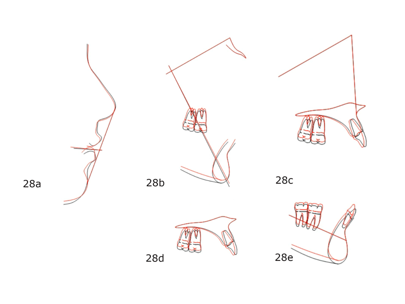 Figs. 28a–e: Superimposition of the pretreatment (black) and post-treatment cephalometric tracings (red) showing the evolution of the treatment.