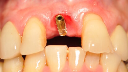 Impianti e monconi di piccolo diametro per la sostituzione di elementi in zona estetica