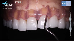 LM-Dental – IETS Protocol for Minimally Invasive Gingival Recession Treatment by Dr. Axel Endruhn LM-Dental – IETS Protocol for Minimally Invasive Gingival Recession Treatment by Dr. Axel Endruhn