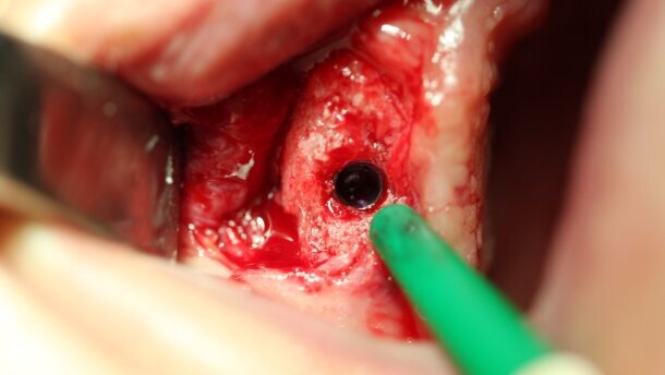 Augmentacja kości szczękowych z zastosowaniem kości ludzkiej świeżo mrożonej