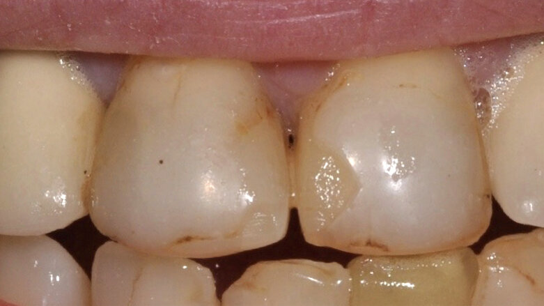 ¿Qué ha cambiado en el fotocurado?