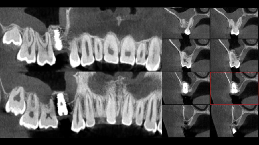Obr. 5: Závěrečný sken z CT s koronárními a sagitálními řezy.