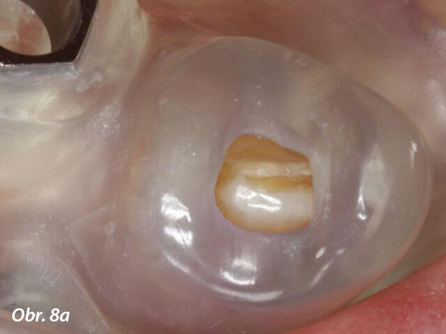 Zvětšený snímek in situ první šablony zhotovené pomocí CAD/CAM (s oporou o zub a sliznici) zachycuje dokonalé dosednutí na zubu 33 (a). Okluzální pohled na druhou šablonu (s oporou o implantát a sliznici) po zavedení implantátů v oblastech zubů 44 a 35 a extrakci zubů 42 a 33 (b).