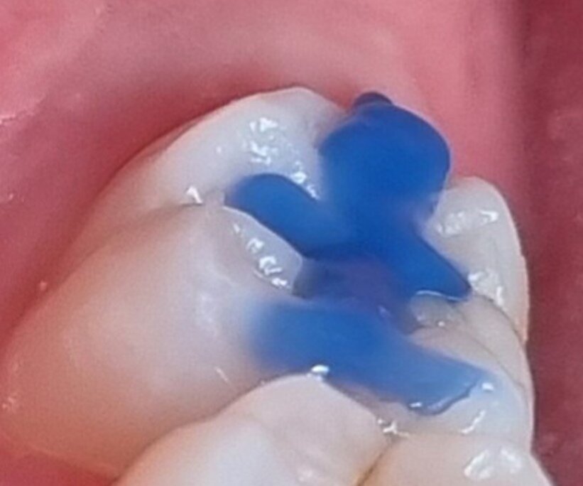 Figs. 2a–c: The anatomy of the occlusal surface was copied with utility resin to create a stamp. The tip of a ball-shaped instrument was incorporated to give a handle to the stamp.