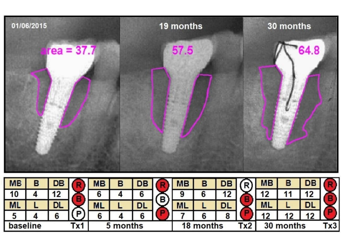 Fig. 5: Example of a lost implant (Case 4), showing changes in radiographic defect (mm2), probing depth (PD; mm) and clinical signs from baseline to 30 months later. Violet = cross-sectional area; MB = mesiobuccal PD; B = buccal PD; DB = distobuccal PD; ML = mesiolingual PD; L = lingual PD; DL = distolingual PD; R = redness; B = bleeding; P = suppuration; Tx1 = first treatment; Tx2 = second treatment; Tx3 = third treatment.
