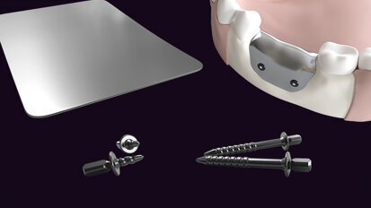 New generation of dental biomaterials launched by botiss New generation of dental biomaterials launched by botiss