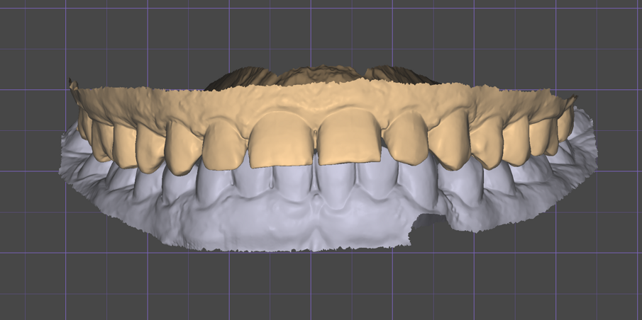 Fig. 5 - Importazione del file .stl nel software Exocad.